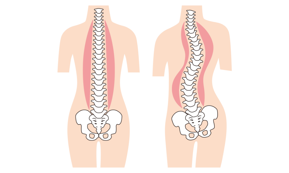 歪んだ背骨と周囲の筋肉